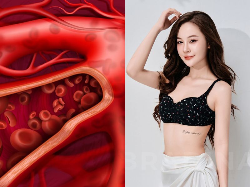 mặc áo ngực đi ngủ có bị ung thư không