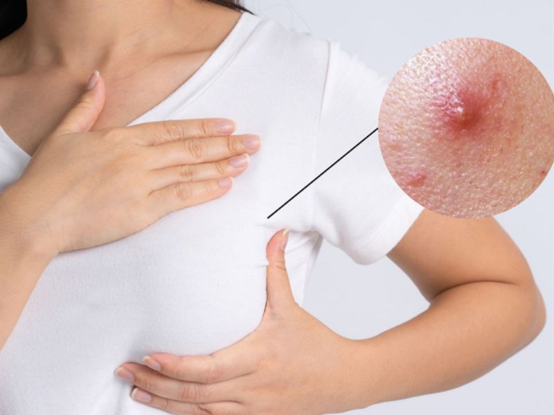 mặc áo lót đi ngủ có bị ung thư không