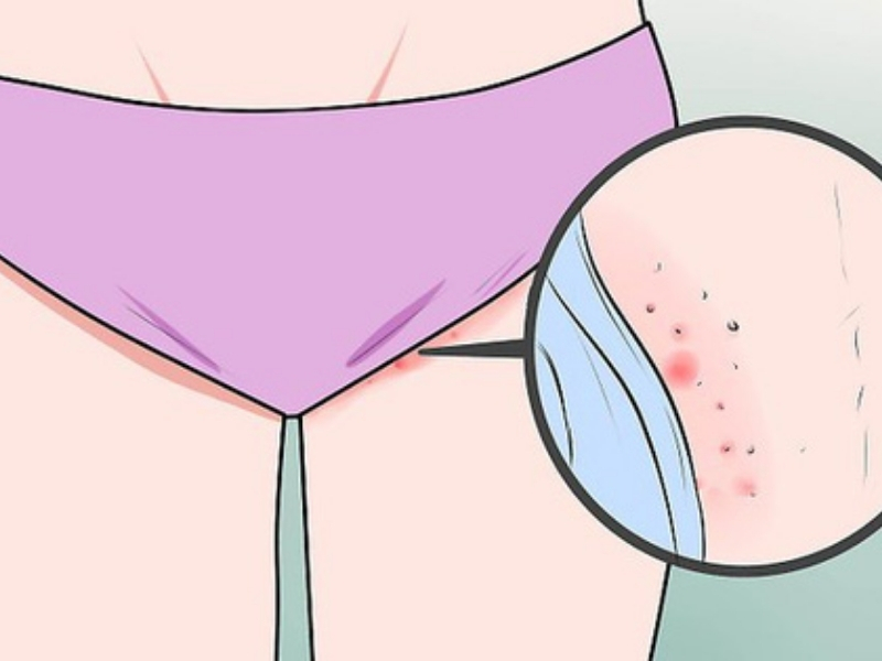 cách mặc quần sịp lọt khe